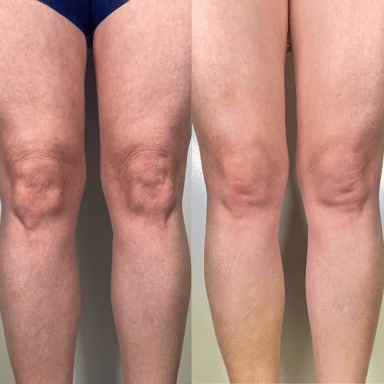 biostimulatory-fillers-knees-haevum