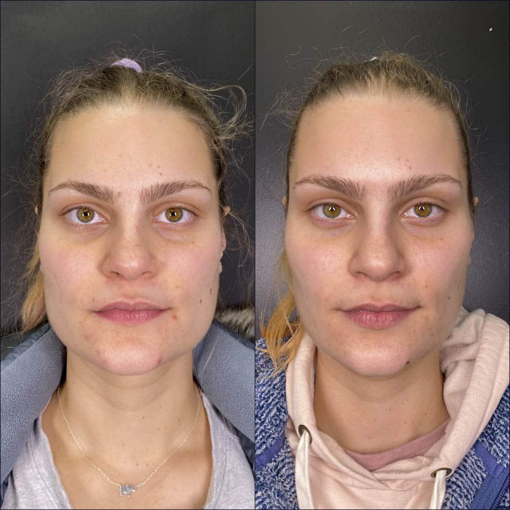 Xeoming Botox Facial Slimming Haevum