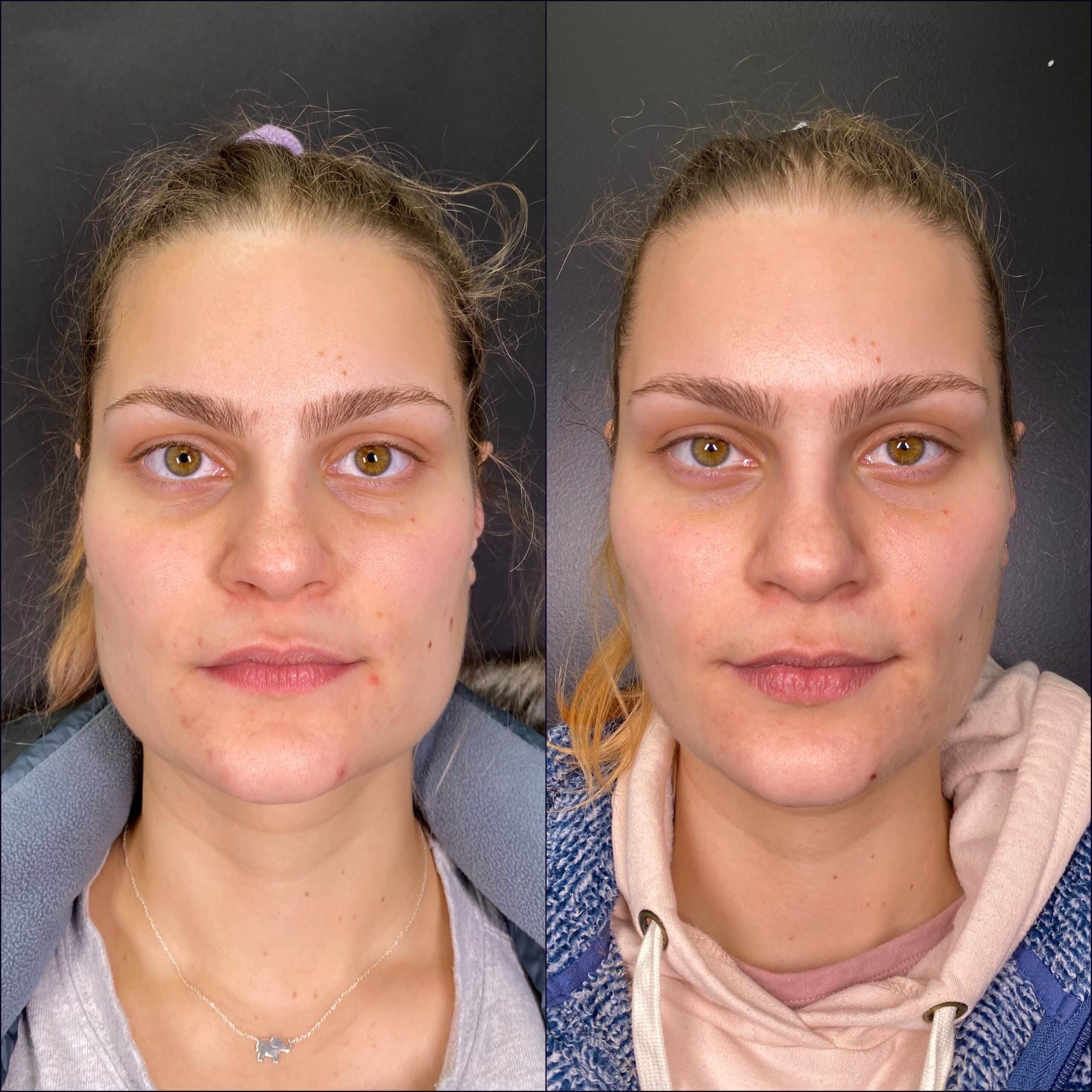 Before And After Masseter Botox For Facial Slimming Straigh Face Scaled
